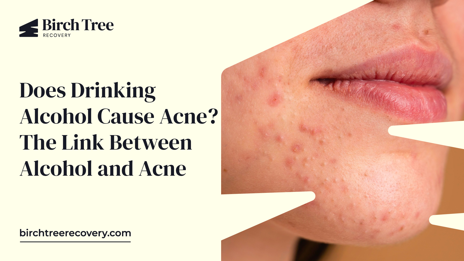 Does Drinking Alcohol Cause Acne? The Link Between Alcohol and Acne